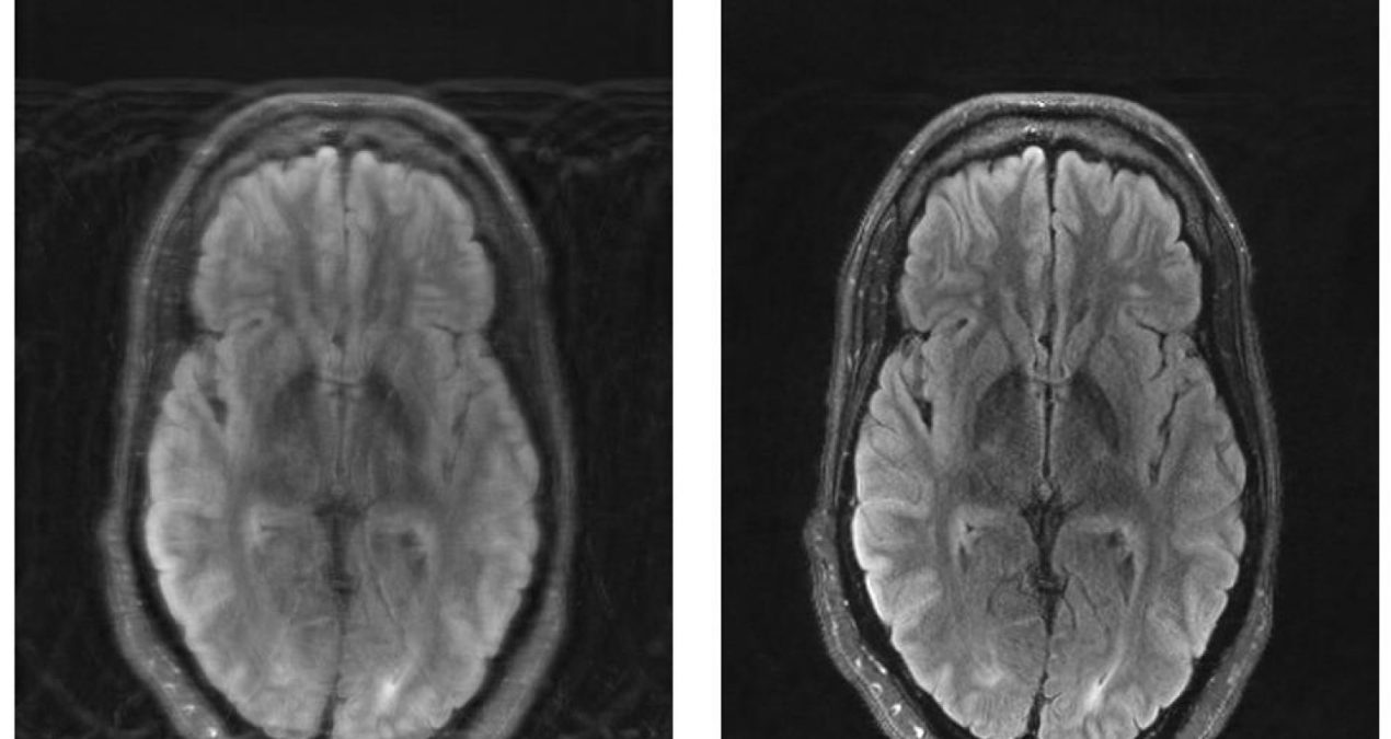 MIT researchers combine deep learning and physics to fix motion-corrupted MRI scans